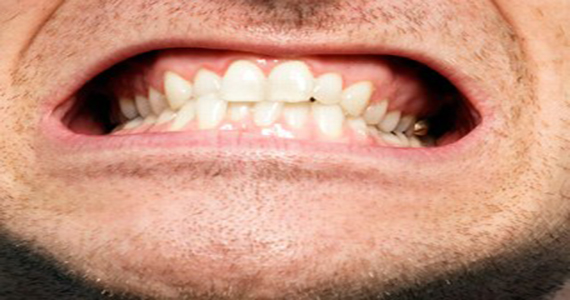 Βρυγμός ή τρίξιμο των δοντιών