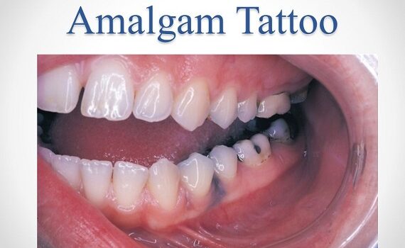 Xρώση Που Προκαλείται Από Εξωγενείς Εναποθέσεις( ΤΑΤΟΥΑΖ ΑΜΑΛΑΓΑΜΑΤΟΣ)