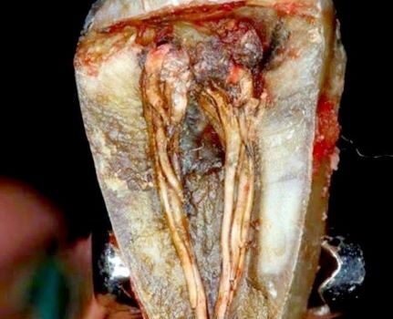 Υπεραιμία του οδοντικού πολφού. Υπεραιμία του οδοντικού πολφού.