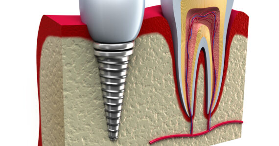 Η απόφαση μεταξύ της διατήρησης ενός φυσικού δοντιού και της αντικατάστασής του με ένα οδοντικό εμφύτευμα είναι μια από τις πιο σημαντικές στην οδοντιατρική