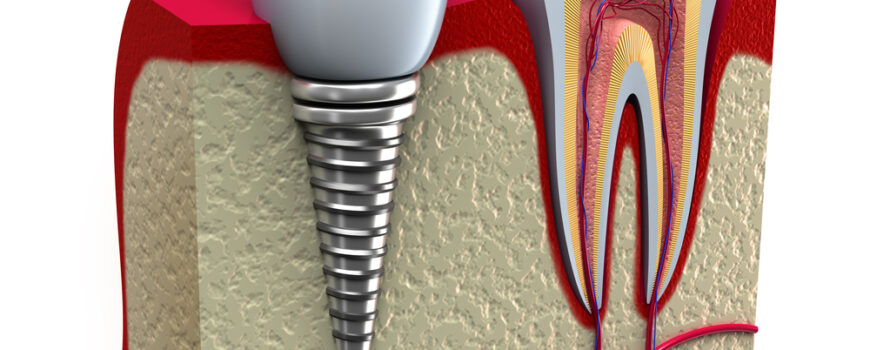 Η απόφαση μεταξύ της διατήρησης ενός φυσικού δοντιού και της αντικατάστασής του με ένα οδοντικό εμφύτευμα είναι μια από τις πιο σημαντικές στην οδοντιατρική Η απόφαση μεταξύ της διατήρησης ενός φυσικού δοντιού και της αντικατάστασής του με ένα οδοντικό εμφύτευμα είναι μια από τις πιο σημαντικές στην οδοντιατρική